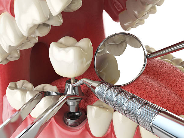Best Emergency Wisdom Teeth Removal in Pleasant Ridge, MI